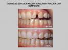 <p>La separación entre los dientes puede corregirse recostruyendo los dientes que afecta a la separación para mejorar el aspecto estético de la sonrisa</p>