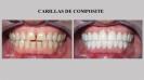 <p>Las carillas estéticas de composite permiten mejorar la el color y la morfología de los dientes sin necesidad de tallarlos. Se trata, además, de un tratamiento mucho más econímoco que las carillas de cerámica.</p>